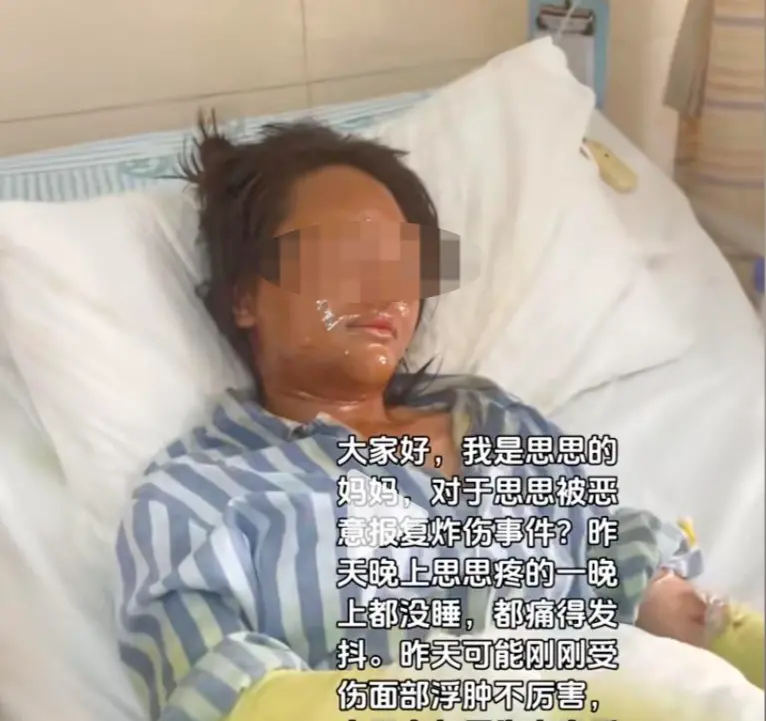 ▲思思面部和雙手嚴(yán)重?zé)齻?，敷滿藥物