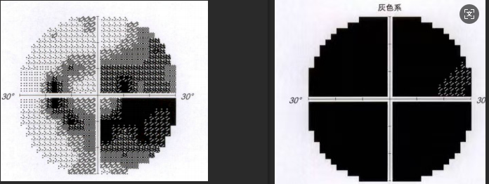  
  小王的右眼视野“全盲”（右图），左眼仅存“中心及旁中心视岛”（左图） 
 