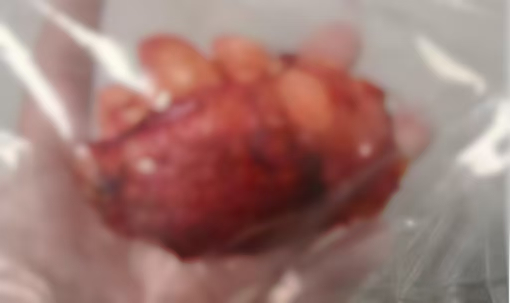  
  剥离出来的脂肪瘤像一块生姜 
 